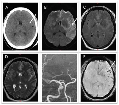 Case report and literature review: fatal cerebral fat embolism following facial autologous fat graft